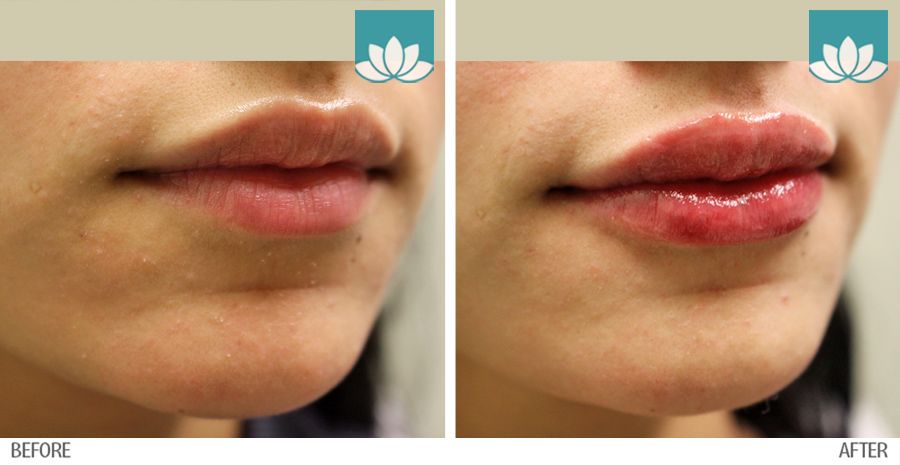 Before and after images of Volbella results at Sunset Dermatology.