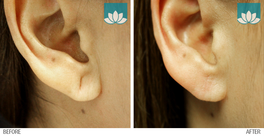 Ear Repair Surgery Results Images