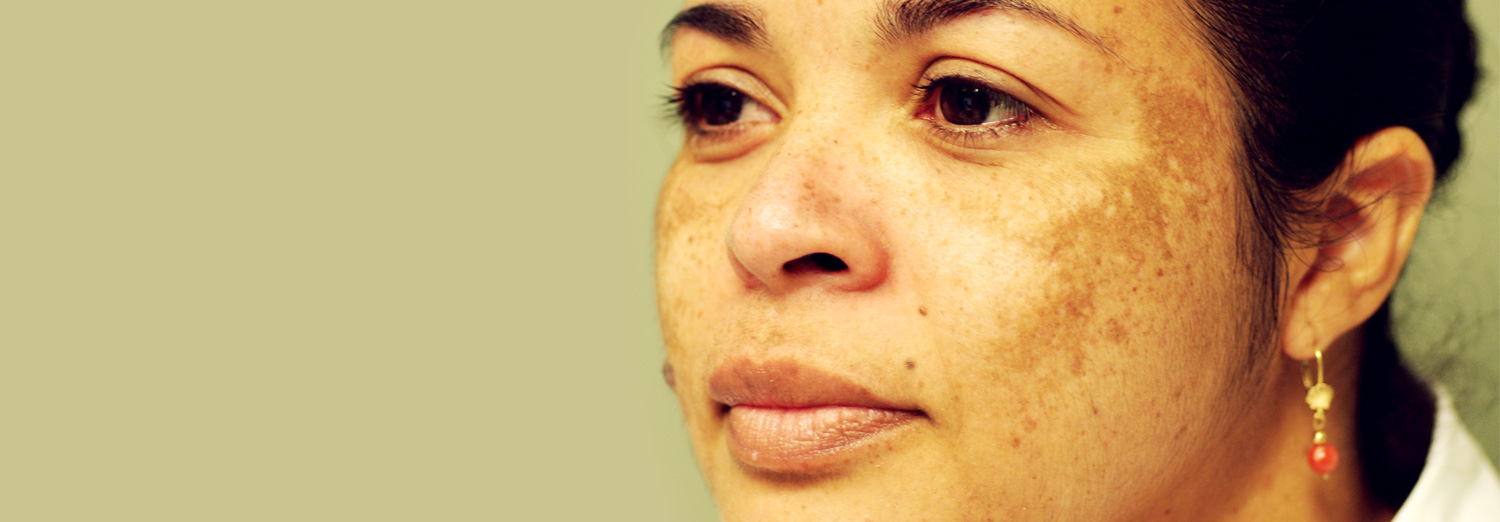 Melasma is a common skin problem that appears as patches of brown discoloration on the face.