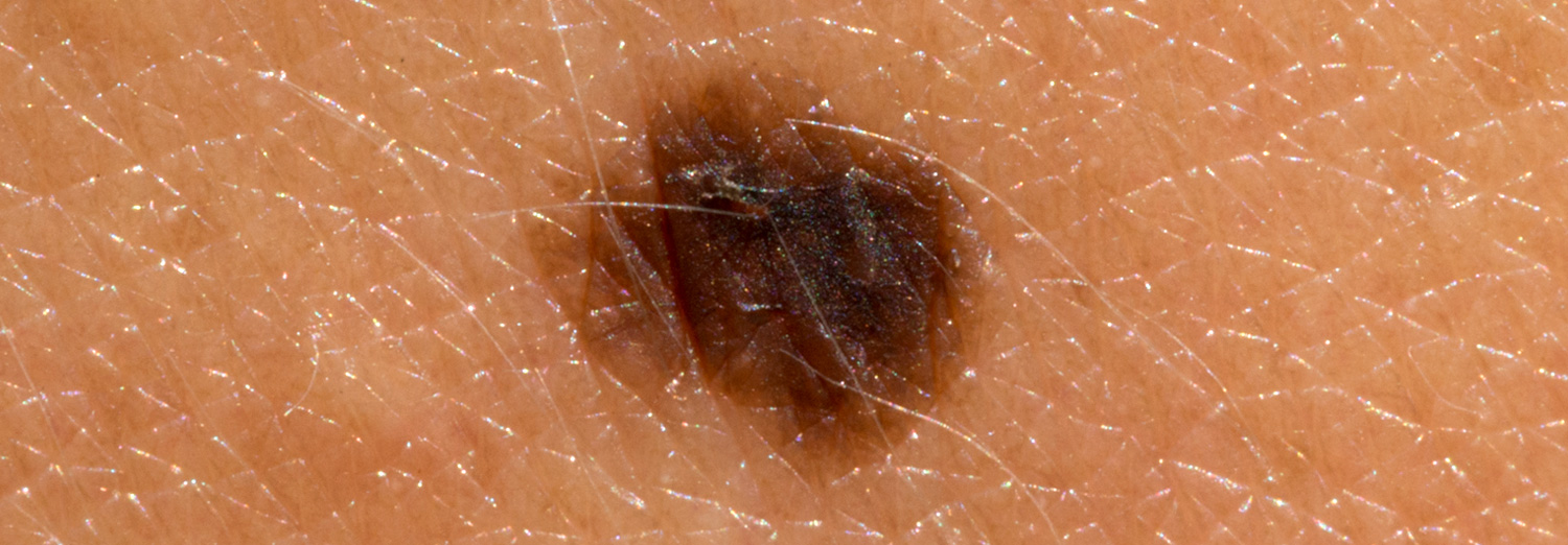 Moles are small, usually harmless spots of dark skin that are caused by clusters of pigment-producing cells