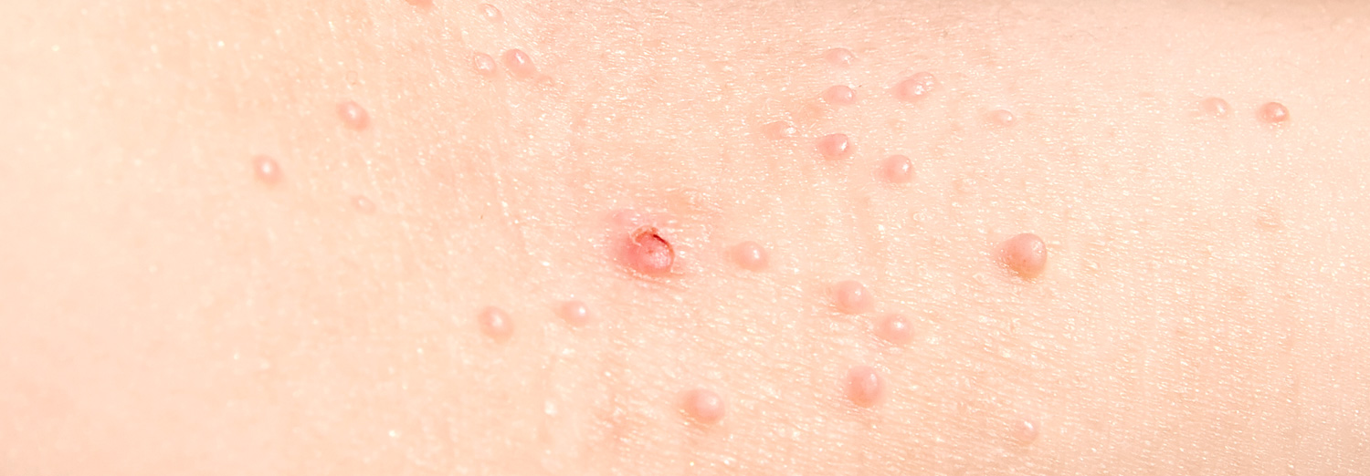 These pink or flesh-colored bumps are caused by a virus that can be spread by skin contact or sharing of clothing and towels