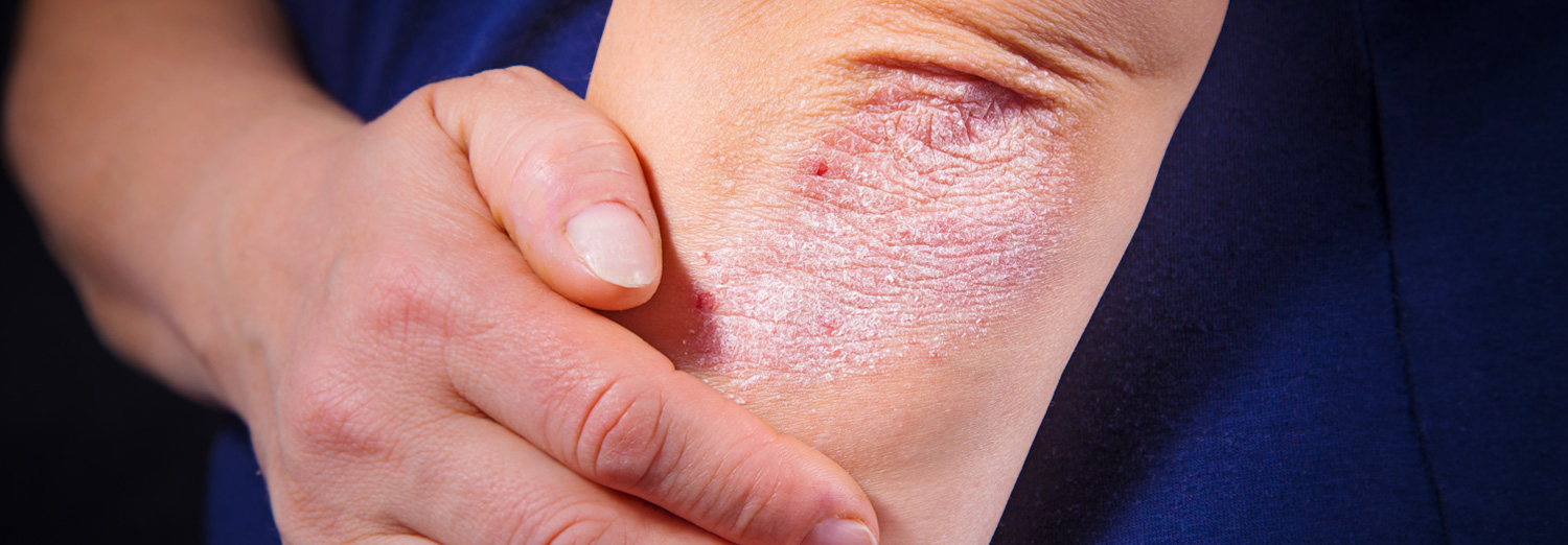 This chronic skin condition causes plaques of red, sometimes itchy skin covered with silvery-white scales most commonly located on the elbows, knees, torso and scalp