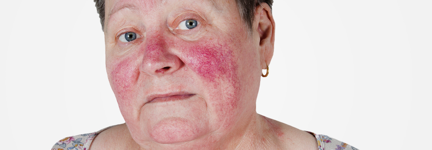 Rosacea is a common skin condition with acne-like bumps of the central face which is sometimes accompanied by facial blushing or flushing.