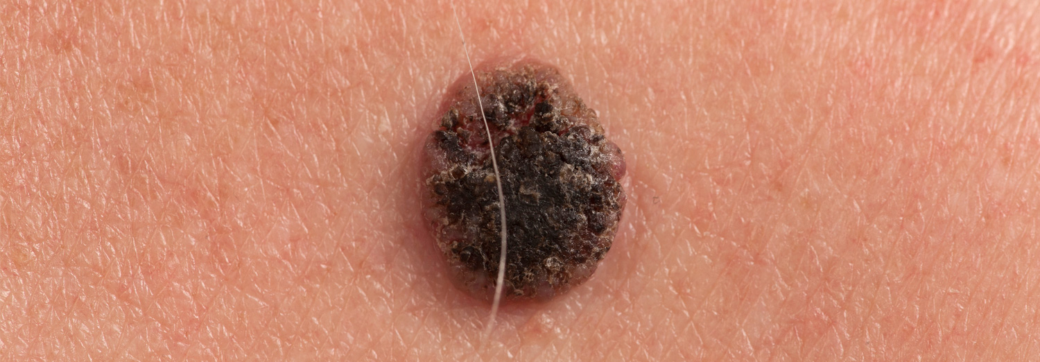 A seborrheic keratosis is a common type of skin growth that can be white, black, tan or brown.