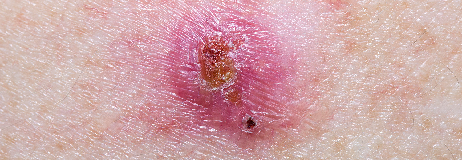 Non-melanoma skin cancers are the most common type of cancer overall, but they are generally curable when caught early