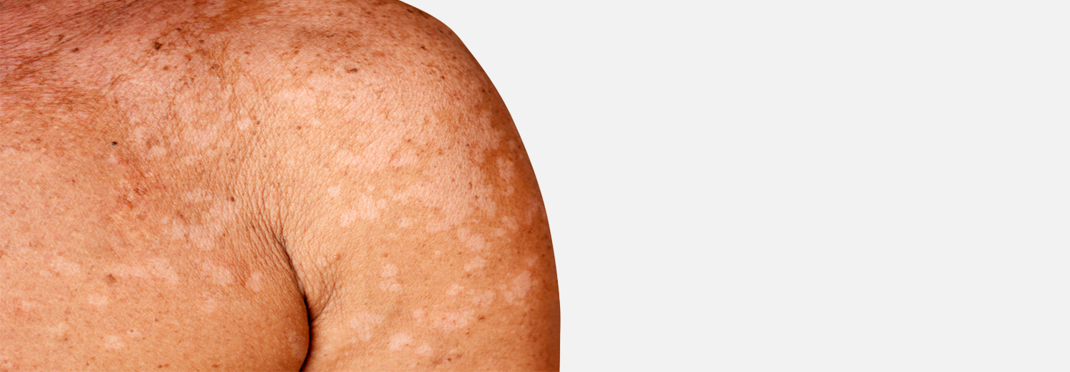 A harmless skin condition caused by an overgrowth of yeast on the skin, tinea versicolor leads to spots of discolored skin that can be dry, itchy and scaly.