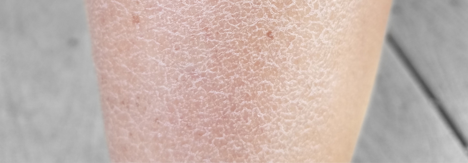 Xerosis is another name for dry skin, which can become uncomfortable and itchy