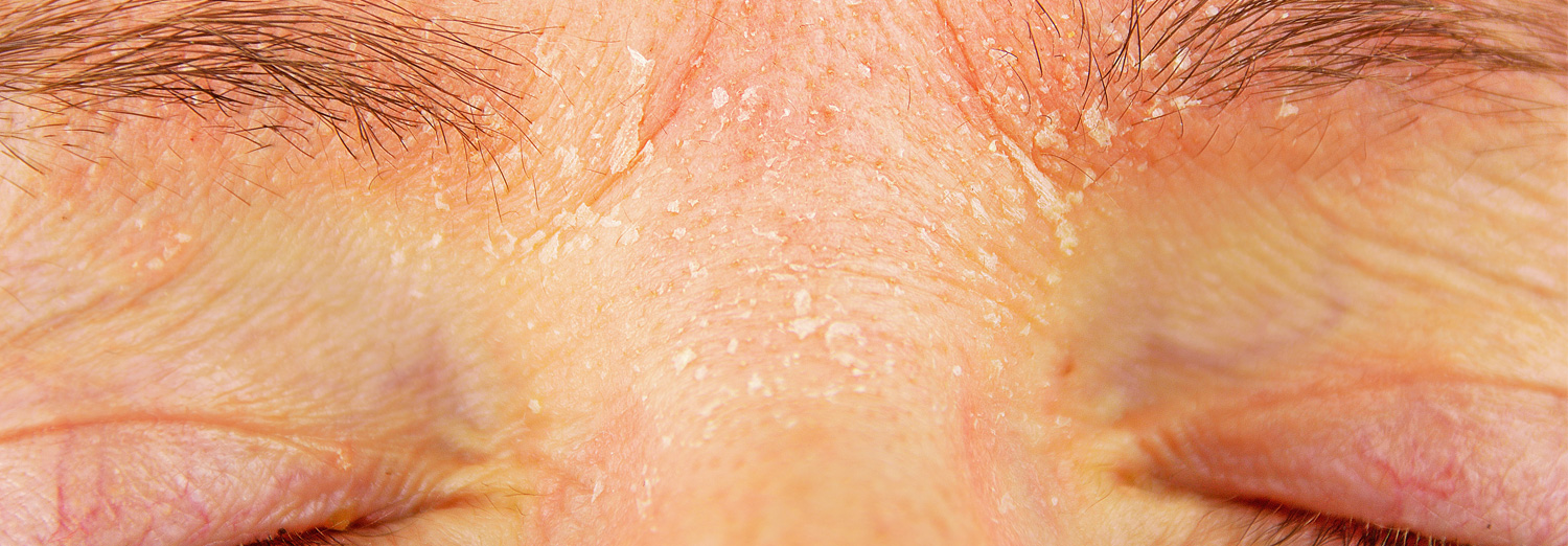 Seborrheic Dermatitis